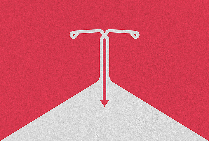 What to Expect When You Remove Your IUD | Giddy